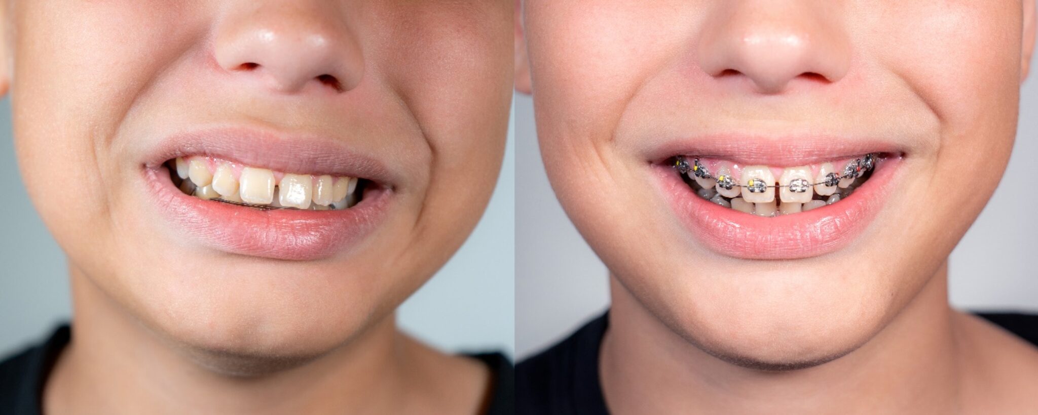 I Have An Overbite What Causes An Overbite Orthodontic Society Of 